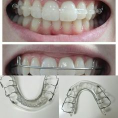 Retainers Aesthetic, Retainer Designs, Byte Aligners, Permanent Retainer, Braces Retainer, Retainer Teeth, Clear Retainers, Smile Tips, Invisalign Braces