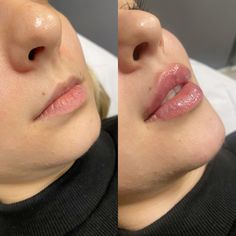 Labios com mais volume, projeção e contorno definidos. Lift Lips Corner, Facial, Vision Board, Collage, Pins