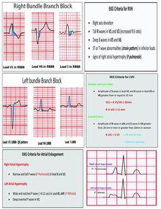 Left Bundle Branch Block, Left Ventricular Hypertrophy, Cath Lab Nursing, Bundle Branch Block