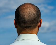 Hairstyles For Balding Crown. There are any references about Hairstyles For Balding Crown in here. you can look below. I hope this article about Hairstyles For Balding Crown can be useful for you. Please remember that this article is for reference purposes only. #hairstyles #for #balding #crown Balding Hairstyles, Hairstyle Crown, Beyonce Hairstyles, Bald Hairstyles, Bald Haircut, Crown Men, Crown Hairstyle, Timeless Hairstyles