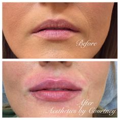 #lips #lipsbycourt #courtcreates #dermalfiller #dermalfillerlips #aesthetics #beautification  #enhance #pout #kiss #results #lipaugmentation #cosmeticinjectables #nurse #injector #cosmetics #lcaparramatta #lcapenrith #lipstolove #aestheticsbycourtney #sydney #sydneylips #mylca Lip Injections Juvederm, Juvederm Lips, Lip Model, Facial Procedure, Lips Inspiration, Botox Lips, Nurse Injector, Facial Fillers, Cosmetic Injectables