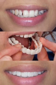 Snap On Smile (par) Inferior E Superior Snap On Smile, Partial Dentures, Permanent Cosmetics, Dental Veneers, Smile Teeth, Dental Procedures, Natural Teeth, Beauty Tips For Skin