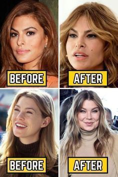 Celebrity Surgery, Cheek Implants, Plastic Surgery Fail, Plastic Surgery Gone Wrong, Face Surgery, Easy Care Hairstyles, Tattoos Men, Celebrity Plastic Surgery