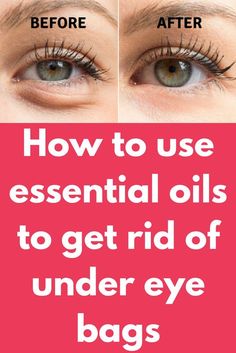 How to use essential oils to get rid of under eye bags Someone rightly said that one can look into a soul by looking at the eyes as they are one of the most beautiful and defining features of our face. Now imagine bags under those eyes. Yes, the confidence level of a person surely drops if he/she is suffering from this condition. It is not a … Puffy Eye, Dry Eyes Causes, Eye Facts, Natural Beauty Care, Confidence Level, Eyes Problems, Under Eye Bags, Health Board, Skin Products