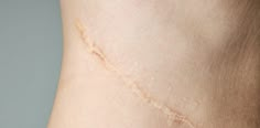 Hypertrophic Scars, Magazine Feature, Stretch Mark Removal, Bad Art, Times Magazine, Art Friend, The New Yorker, Short Story