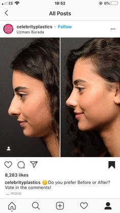 Noses For Round Faces, Rhinoplasty Droopy Tip, Saddle Nose Deformity, Perfect Nose Rhinoplasty, Rhinoplasty Before After, No Jawline, Nose Job Inspiration