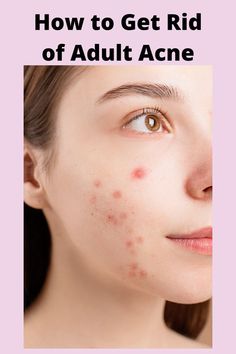 This article will tell you the 5 best ingredients to include in your skincare routine to get rid of adult acne. It gives some product suggestions that include those ingredients. I am someone who struggled with adult acne and I finally figured out what ingredients work best to get rid of the acne and I wanted to share! #acne #adultacne #howtogetridofacne #skincare #skincareingredients Daytime Skincare Routine, Acid Peel, Cheap Skin Care Products, Acne Studio, Drugstore Skincare, Benzoyl Peroxide, Chemical Peel, How To Get Rid Of Acne, How To Treat Acne