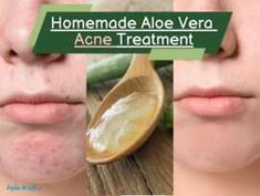 Henna For Hair Growth, Aloe Vera Acne, Upper Lip Hair Removal