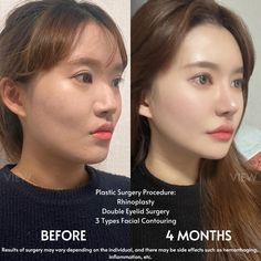 For more information: ❤️Whatsapp: +82-10-2103-7174 💛Kakao: viewinquiry 💚LINE: viewinquiry ✉️E-mail: eng_viewps@viewclinic.com 💎Website: www.viewplasticsurgery.com Jaw Reduction Surgery, Change Appearance, Reduction Surgery, Perfect Nose, Nose Job, Official Account, Girls Sweet, Green Juice