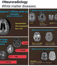 an image of neuroradiollogy and white matter in the brain, with different areas labeled