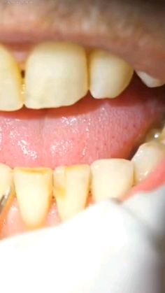 How To Remove Plaque From Teeth At Home, Cloves For Teeth, Clear Teeth, Natural Teeth Whitening Diy, Teeth Whitening Homemade, Bad Teeth, Teeth Whitening Remedies, Teeth Whitening Diy