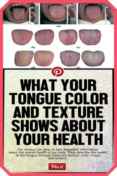 What Does Your Tongue  - Say About Your Health? by John McClane | This newsletter was created with Smore, an online tool for creating beautiful newsletters for educators, businesses and more Lichen Planus, Piece Of Pizza, Canker Sore, Tongue Health, The Tongue, Cold Sore, Health Guide, Nail Health