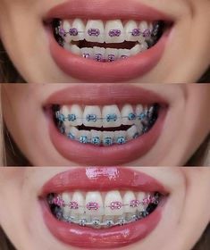 Brackets Aesthetic, Braces And Glasses, Braces Smile, Logo Design Women, Dental Jewelry