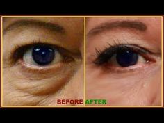 3 DAYS TO REMOVE PUFFY EYES AND EYE BAG EFFECTIVELY, DRY UNDER EYES AND WRINKLES AROUND THE EYES - YouTube Undereye Bags Remedy, Bags Under Eyes, Dry Under Eyes