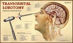 an image of a diagram of the human head and brain with tools in front of it