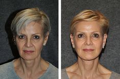 Ponytail Facelift, 8 Point Face Lift, Instant Face Lift Makeup, Lower Face And Neck Lift, Forehead Lift, Facial Aging, Chin Augmentation