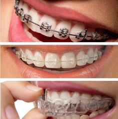 Orthodontics Teeth, Braces Food, Dental Wallpaper, Dentist Art, Dental Advertising