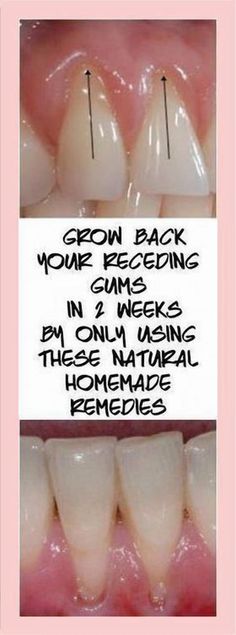 Revitalize your gums naturally with these effective remedies designed to help restore receding gums. Grow Back Receding Gums, Gum Recession, Teeth Health, Receding Gums, Gum Health, Health And Fitness Articles, The Dentist, Oral Health Care, Teeth Care