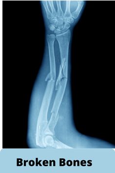 an x - ray shows the bones of a person's foot