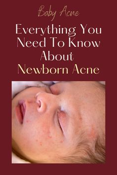 What's the best way to treat baby acne? Find out in this article. It includes how to identify it, what causes it and how you can prevent or lessen its symptoms. You'll also learn about different treatments that are available for your little one. We've got everything you need when it comes to treating baby acne! Baby acne is a condition that affects many babies before their first birthday. Baby Heat Rash, Redness Pimple, Acne Diet, Heat Rash, Oily Face, Diy Acne