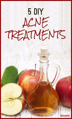 Take care of your skin without all the prescription medicine! Food Acne, Acne Overnight, Pimples Remedies, Prevent Pimples, Diy Acne, Acne Treatments, Natural Acne Remedies, Natural Acne, Popular Now