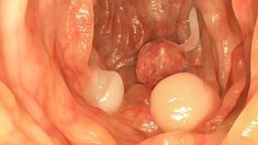 Colonic polyps are growths that appear on the surface of the colon. Learn about colonic polyp symptoms, causes, treatment, and prevention. Cleaning Your Colon, Videos Cooking, Types Of Cancers, Warning Signs, Home Remedies, Food Videos, Signs, Health