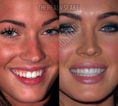 Celebrity Veneers, Models With Gaps In Teeth, Perfect Smile Teeth Women, Hollywood Smile, Celebrity Teeth Women, Veneers Before And After, Beautiful Smile Teeth Aesthetic, Celebrity Smiles Teeth, Hollywood Smile Teeth