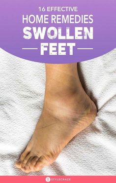 Sore Feet Remedies, Natural Headache, Natural Headache Remedies, Home Health Remedies, Health And Fitness Tips