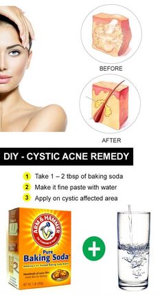 15 DIY Home Remedies for Cystic Acne Treatment Cystic Acne Remedies, Diy Acne, Natural Acne, Diy Kosmetik, Home Remedies For Acne, How To Get Rid Of Pimples, Acne Causes, Diy Remedies, Cystic Acne