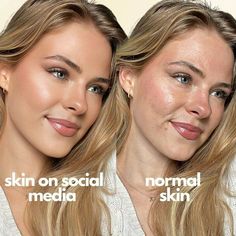 Filter Is Not Real Life Acne Is Normal, Real Skin Texture, Acne Positivity, Skin Positivity, Celebrity Acne, Face Mapping Acne, Eyeliner Techniques, Real Skin, Celebrity Skin