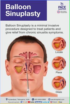 Balloon Sinuplasty is a minimal invasive procedure designed to treat patients and give relief from chronic sinusitis symptoms. #sinusitis #chronic #ent #pacehospitals #otolaryngology #sinus #sinusinfection #fess #BalloonSinuplasty #health #sinusrelief Sinusitis Symptoms, Chronic Sinusitis, Sinus Relief, Sinus Infection, Balloons, Health