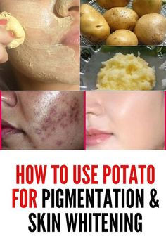 Pigmentation Remedy, Potato For Skin, Potato Face, Home Remedies For Skin, روتين العناية بالبشرة, Skin Remedies