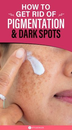 Pigmentation Remedy, Brown Spots On Skin, Home Remedies For Skin, Skin Pigmentation