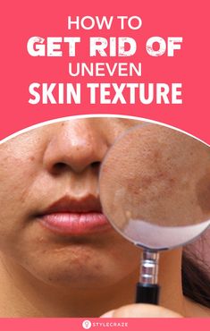 How To Get Rid Of Uneven Skin Texture On Face: If you have paid attention to the skin on your face, you would have noticed that sometimes, the texture of the skin on some areas of the face is very different from the rest of it. Want to know why this happens? We have put together a list of home remedies which will help you in treating this skin issue in a far gentler way by making use of ingredients available at home. #Skin #SkinCare #SkinCareTips Spots On Forehead, Brown Spots On Hands, Brown Age Spots, Brown Spots On Skin, Textured Skin, Brown Spots Removal, Brown Spots On Face, Skin Spots