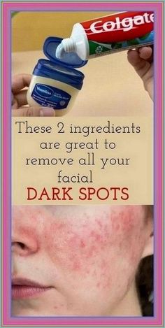 These 2 ingredients are great to remove all your facial DARK SPOTS Vaseline Uses For Face, Vaseline Uses, Face Wrinkles