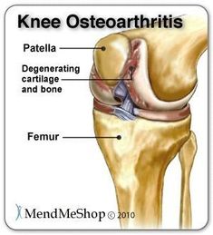 It is not the bones inside the knee that provide stability. It is the soft tissue (tendons, ligaments, muscles, menisci) that holds the femur (thigh bone), the tibia (shinbone), the fibula (the slender bone in the lower leg) and the patella (kneecap) together at the joint. Pain Relief Cream, Lower Leg, Muscle Pain