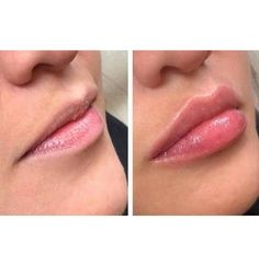 Cupids Bow Lips, Full Lips Makeup, Smooth Skin Body, Face Makeover, Botox Cosmetic