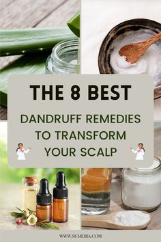 Collage of 4 images showing different dandruff remedies: apple cider vinegar, aloe vera gel, baking soda, and coconut oil. Represents natural ways to treat dandruff and promote scalp health. Diy Shampoo For Dandruff, Treating Dandruff Naturally, Types Of Dandruff, Hair Mask For Dandruff Oily Scalp, Homemade Hair Oil For Dandruff, Reduce Dandruff Remedies, Natural Remedy For Dandruff, Best Shampoo For Oily Hair And Dandruff, Dandruff And Itchy Scalp Remedy