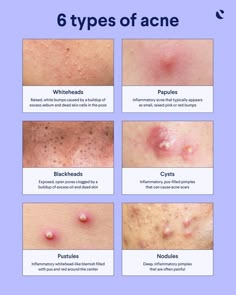 Nodule Acne, Acne Types, Different Types Of Acne, Forehead Acne, Pimples Under The Skin