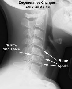 Spinal Degeneration, Spine Problems, Vertebral Artery, Cervical Pain, Referred Pain, Cervical Spondylosis, Hip Problems, Spinal Nerve, Bone Diseases