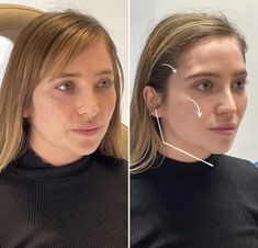 PDO Thread lift for the jaw and brows! Stunning natural results with a subtle lift Kpop Plastic Surgery, Cosmetic Injector, Jaw Reduction Surgery, Pdo Thread Lift, V Line Surgery, Chin Filler, Pdo Threads, Korean Plastic Surgery