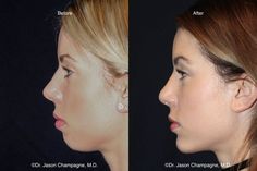 Chin Implant, Facial Bones, Jaw Surgery, Facial Surgery, Facial Plastic Surgery