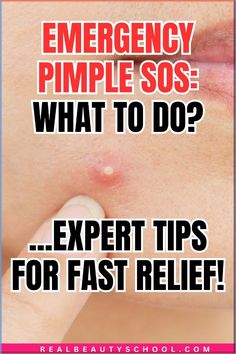 Learn how to get rid of a big pimple with this easy quick fix! Don't panic when a big pimple strikes! Our expert tips will come to your rescue for fast relief. Discover the secrets to banishing blemishes and regaining your confidence. - How to heal a big pimple fast - how to remove a big pimple fast - how to deal with a big pimple fast - tips for pimples - big pimple remedy Homemade Remedy For Pimples, Overnight Zit Remedy Fast, Get Rid Of A Pimple Instantly, Home Remedy For Pimples Overnight, Pimple Redness Reducer, How To Deal With Pimples, How To Pop Pimples Safely, Deep Pimple Remedies Overnight, How To Bring A Pimple To A Head Fast