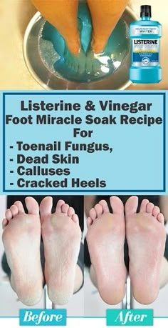 Listerine Foot Soak, Foot Soak Recipe, Cracked Heels, Foot Soak, Beauty Remedies, Skin Care Remedies, Foot Care, Health And Beauty Tips