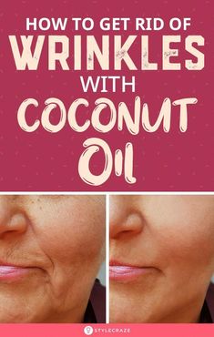 Coconut oil hydrates the skin and reduces the appearance of wrinkles. Read this article to learn about the different ways of using coconut oil for wrinkles. Coconut Oil Uses For Skin, Get Rid Of Wrinkles, Lotion For Oily Skin, Wrinkle Remedies, Facial Wrinkles, Coconut Oil Uses, Skin Care Wrinkles, Baking Soda Shampoo, Moisturizer For Oily Skin