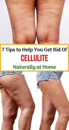 7 Tips to Help You Get Rid Of Cellulite Naturally at Home Estrogen Dominance, Loving Your Body, Stubborn Belly Fat, Medical Professionals, Lose Belly, Lose Belly Fat, Statistics, Natural Health, Hair Removal