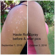 Sunburn Relief, Black Skin Care, Skin Disorders, After Photos, Skin Care Regimen, Doterra, Apple Cider