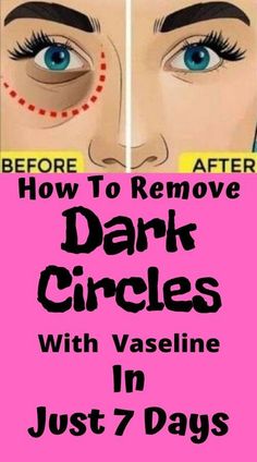 removedarkcircles,undereyedarkcircles,      vaselinehacks,emovedarkcircleswithvaseline,       getridofdarkcircles,vaseline,darkcircles Dark Spots Under Eyes, Dark Circles Around Eyes, Dark Circle Remedies, Dark Eye Circles, Dark Spots On Skin, Skin Care Wrinkles