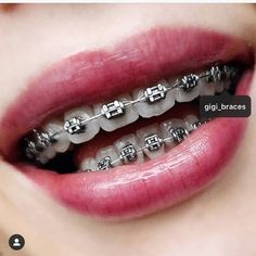 Braces Colors Ideas Cute, Braces Cute