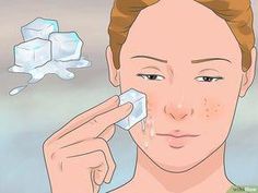 Pimples with no head, also called blind pimples, acne cysts, or nodules, are pimples that are so deep under the skin that they cannot release pus. Because the inflammation is deep under the skin and close to the nerves, these pimples are... Deep Pimple, Nodule Acne, Back Pimples, Cystic Pimple